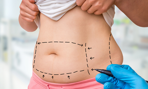 Liposuction